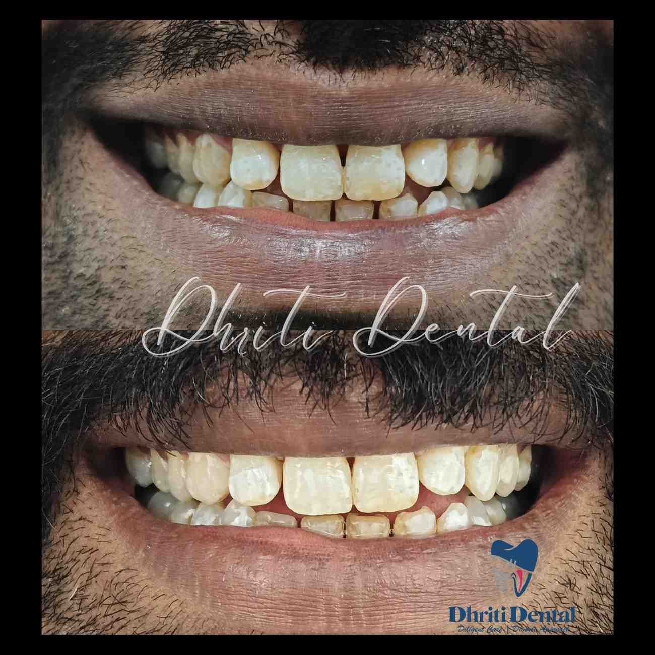 Teeth whitening - before and after.